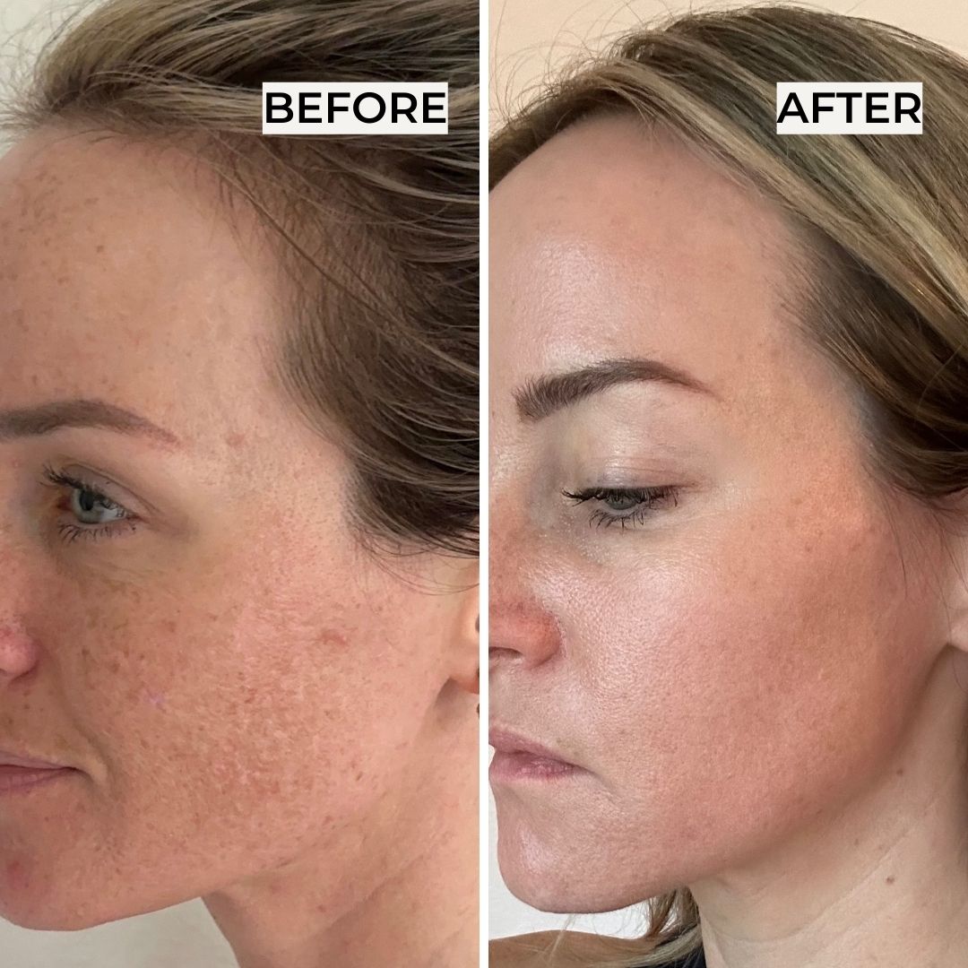 My Painfully Honest Fraxel Review - Before/After Pics - So Much Life