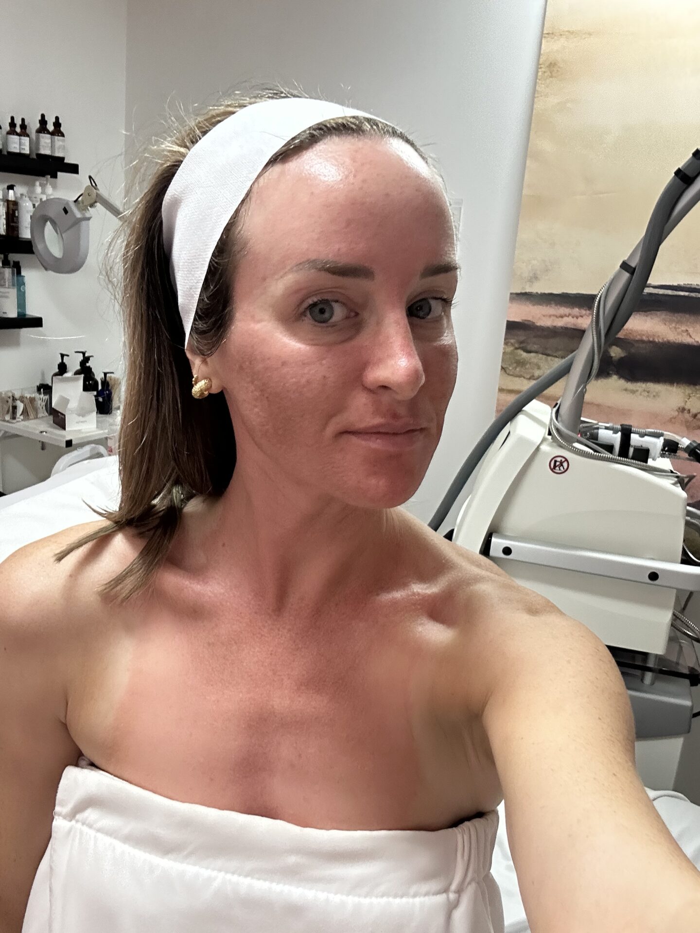 My Painfully Honest Fraxel Review - Before/After Pics - So Much Life